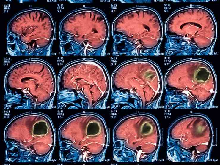 Tumore al cervello, sintomi