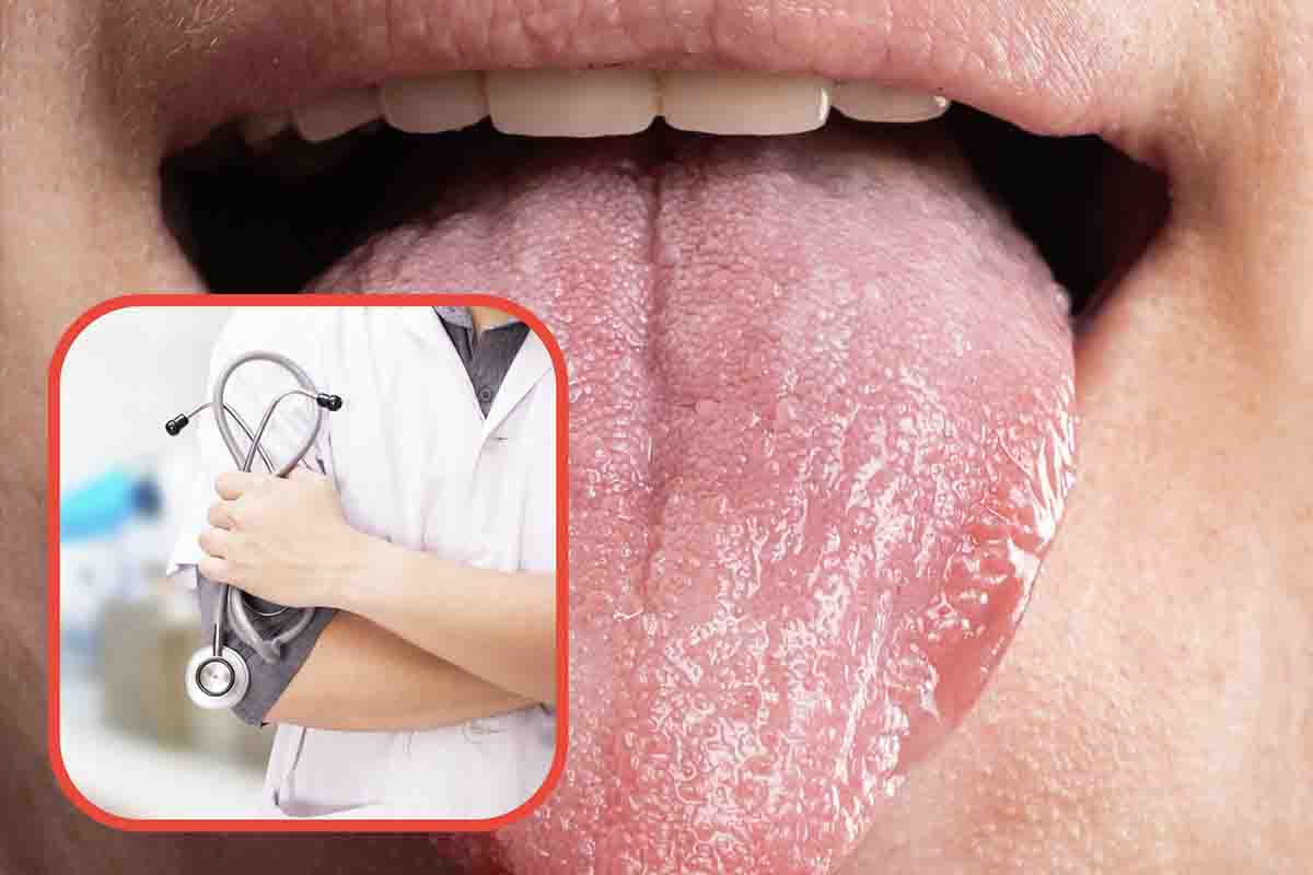 I segni sulla lingua possono nascondere una patologia importante