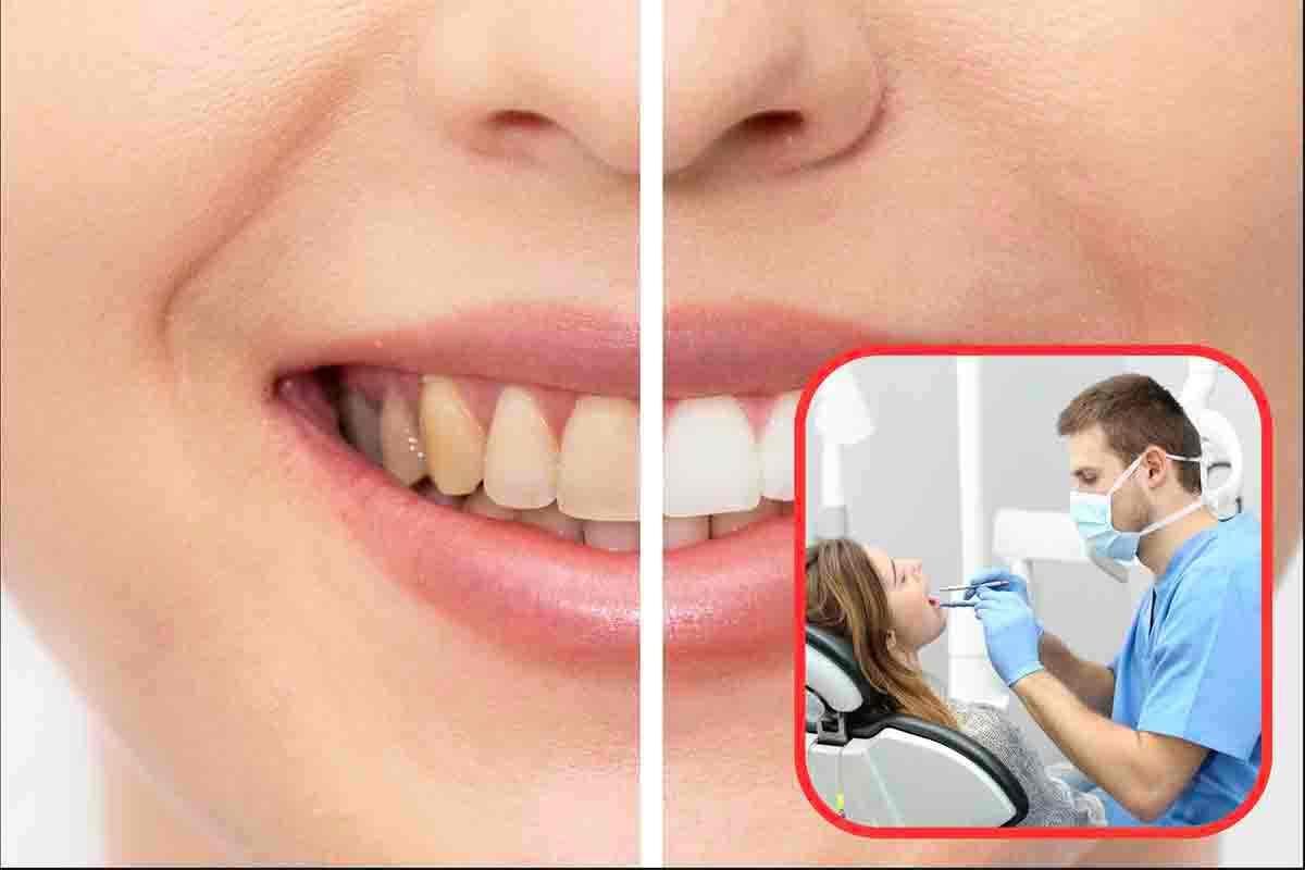 Consigli per evitare l'ingiallimento dei denti